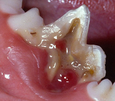 Not Treating Dental Fractures