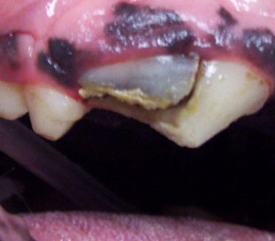 Slab Fractures of the Upper Premolars